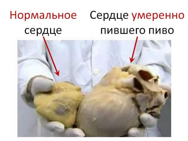 Порівняння серця здорової людини та пиття пива